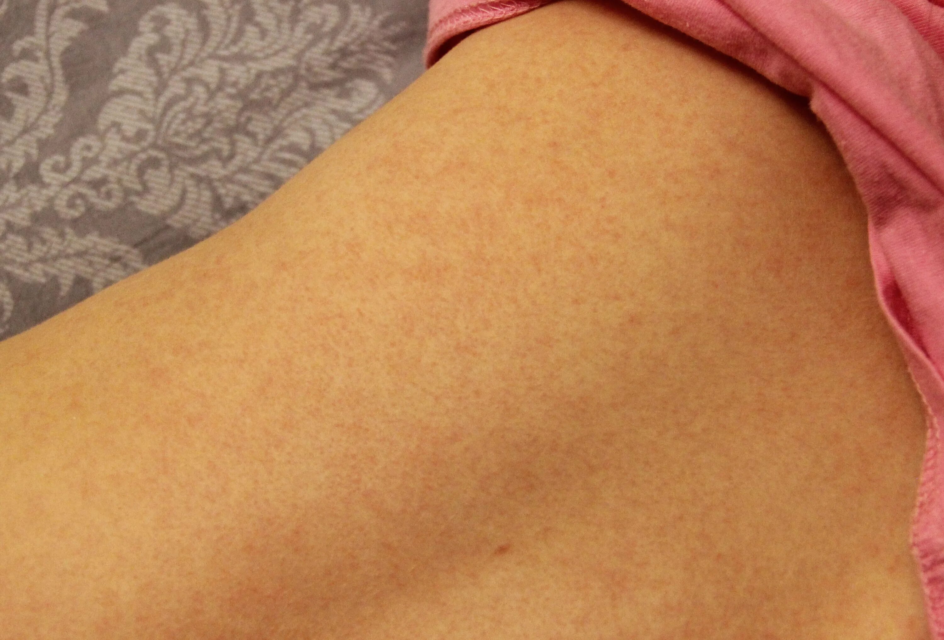 По фото определить сыпь на коже Сыпь(спина) 10.12 / VFL.Ru - ваш личный фотохостинг
