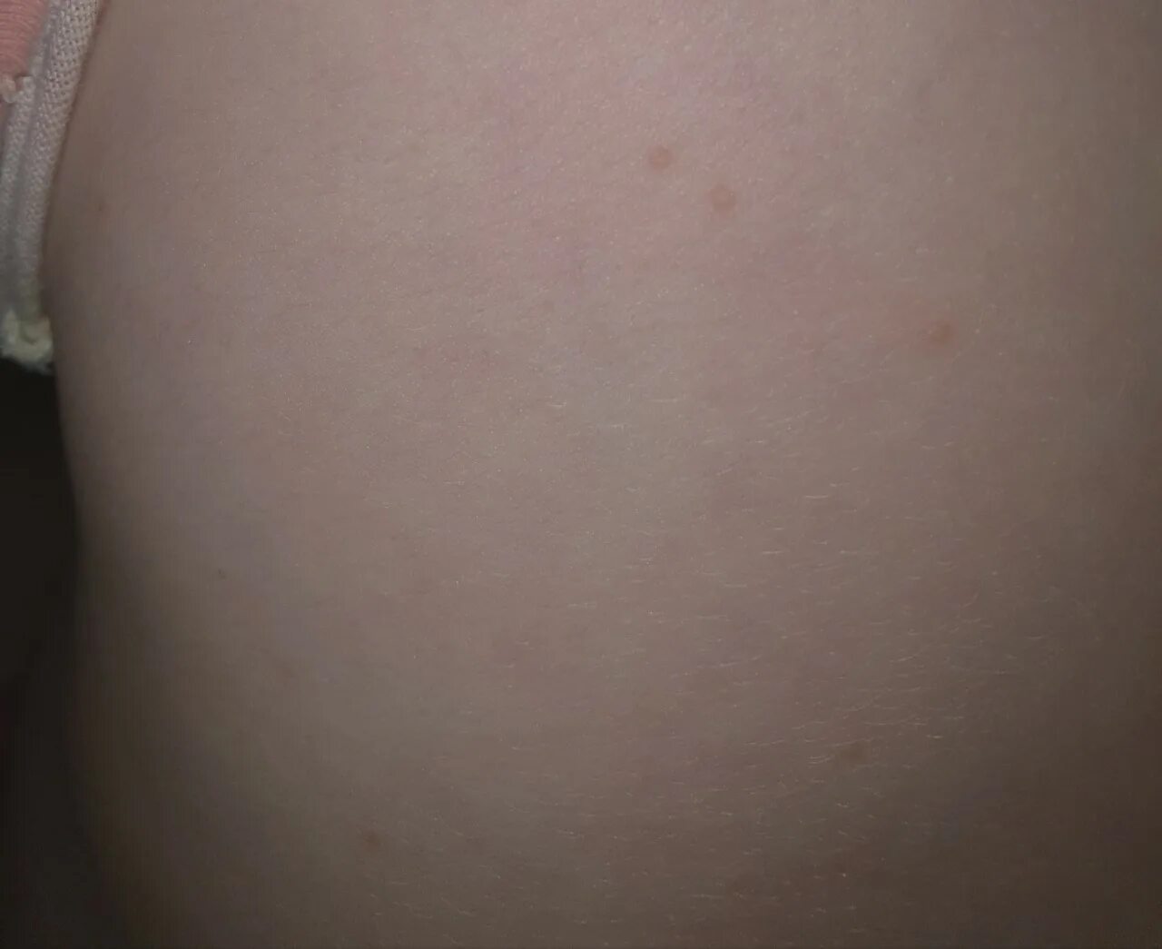 По фото определить сыпь на коже Сухая мелкая сыпь, что это? - Вопрос дерматологу - 03 Онлайн