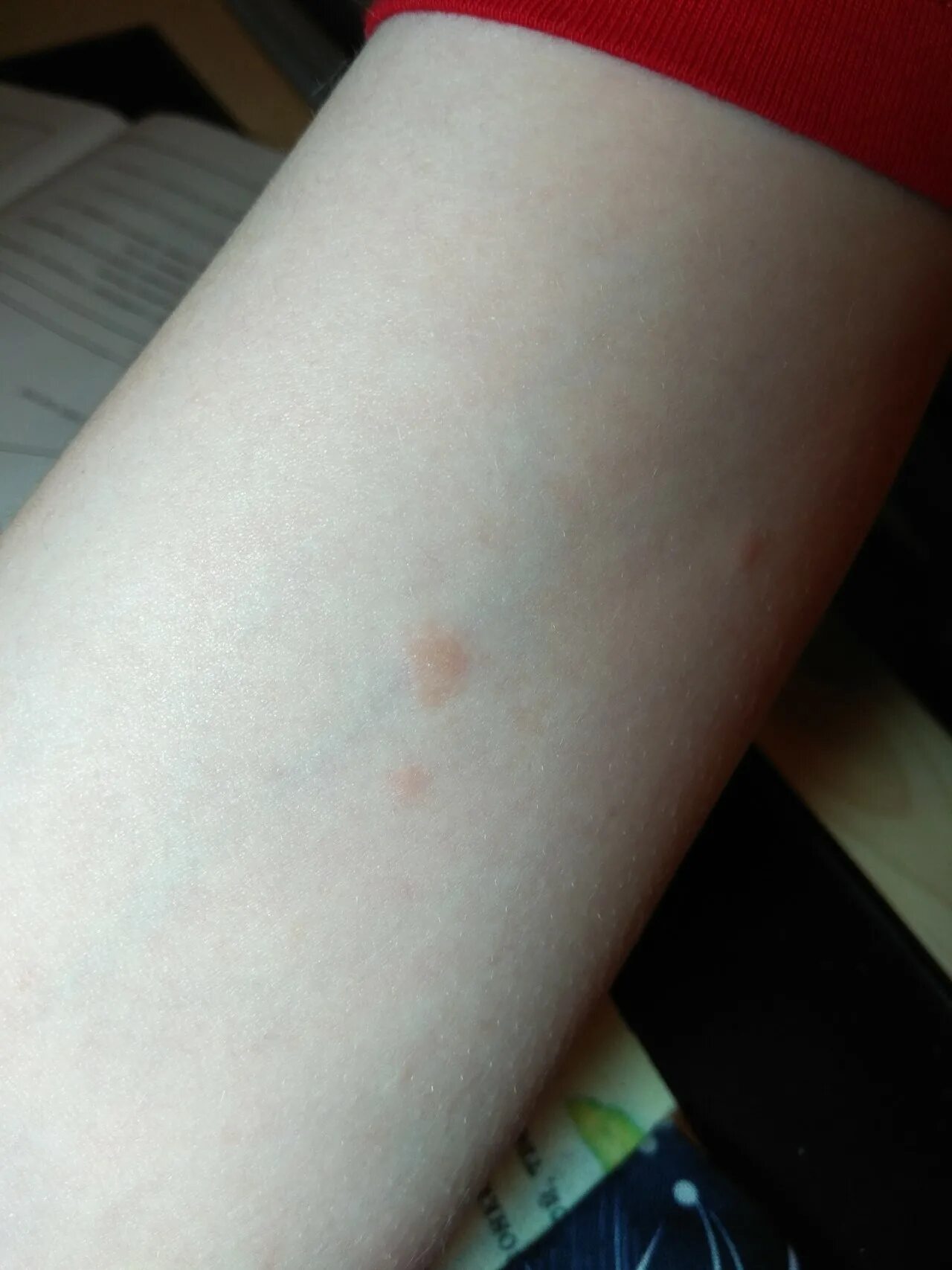 По фото определить сыпь на коже Пятна и сыпь на коже - Вопрос аллергологу - 03 Онлайн