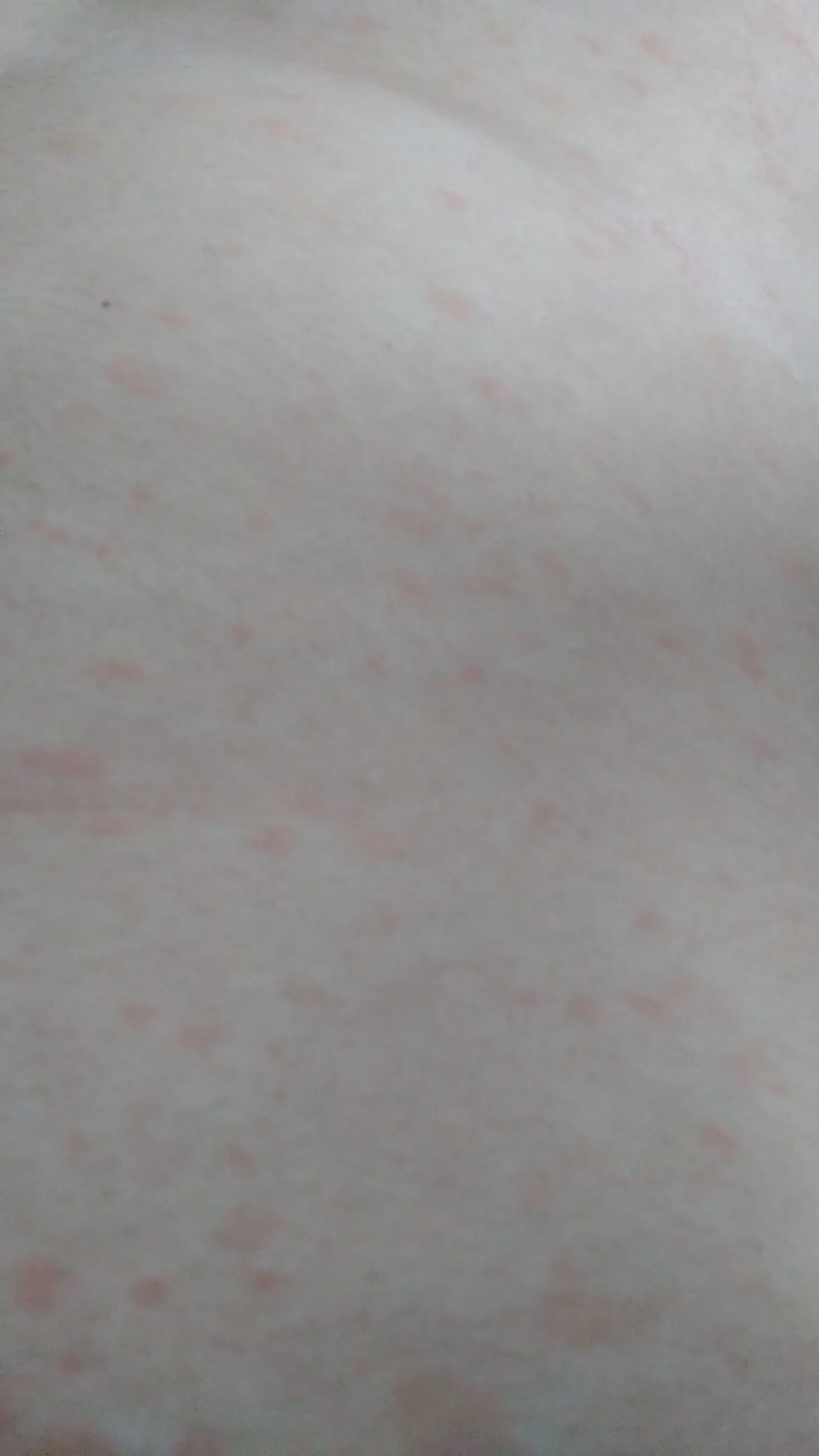 По фото определить сыпь на коже Ответы Mail.ru: Сыпь на теле.