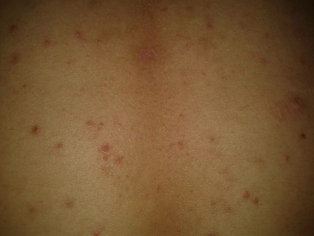 По фото определить сыпь на коже Прыщики на спише, похоже на сыпь. - Вопрос дерматологу - 03 Онлайн