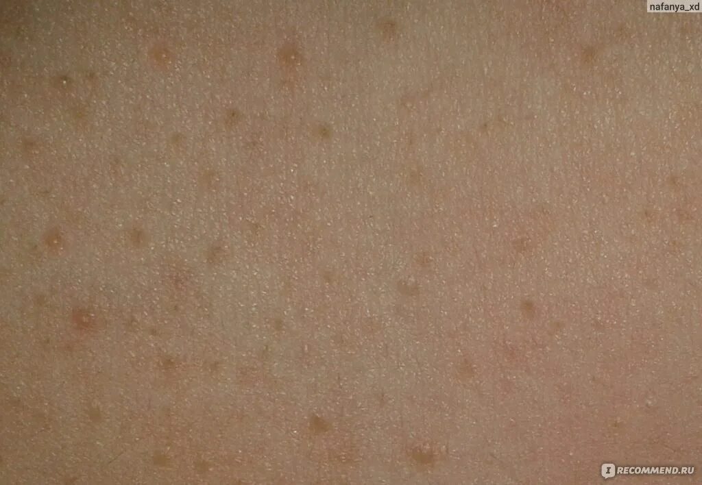 По фото определить сыпь на коже Гель-скраб для тела Salon spa collection Гель - пилинг для душа - "Аллергия и те