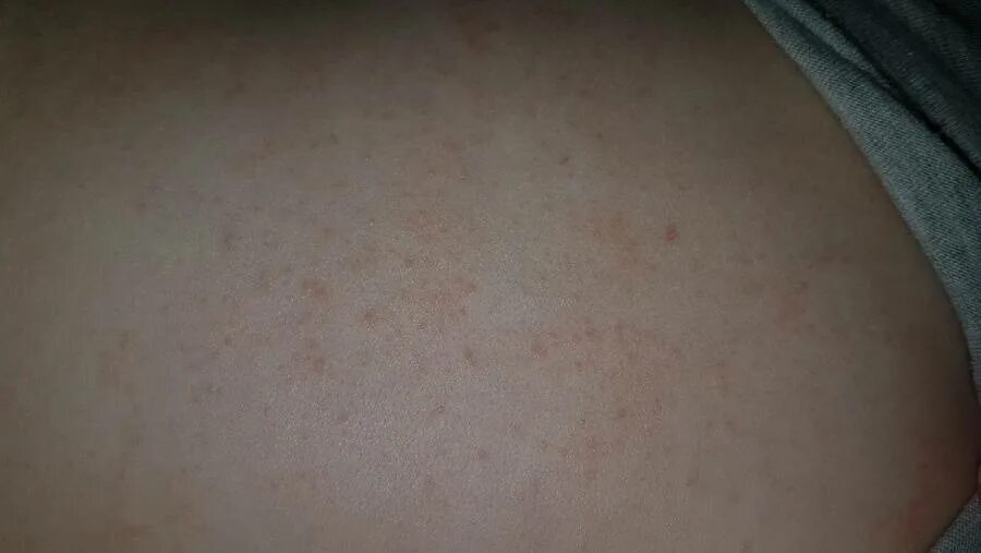 По фото определить сыпь на коже Сыпь у грудничка на спине, теле, коже: причины