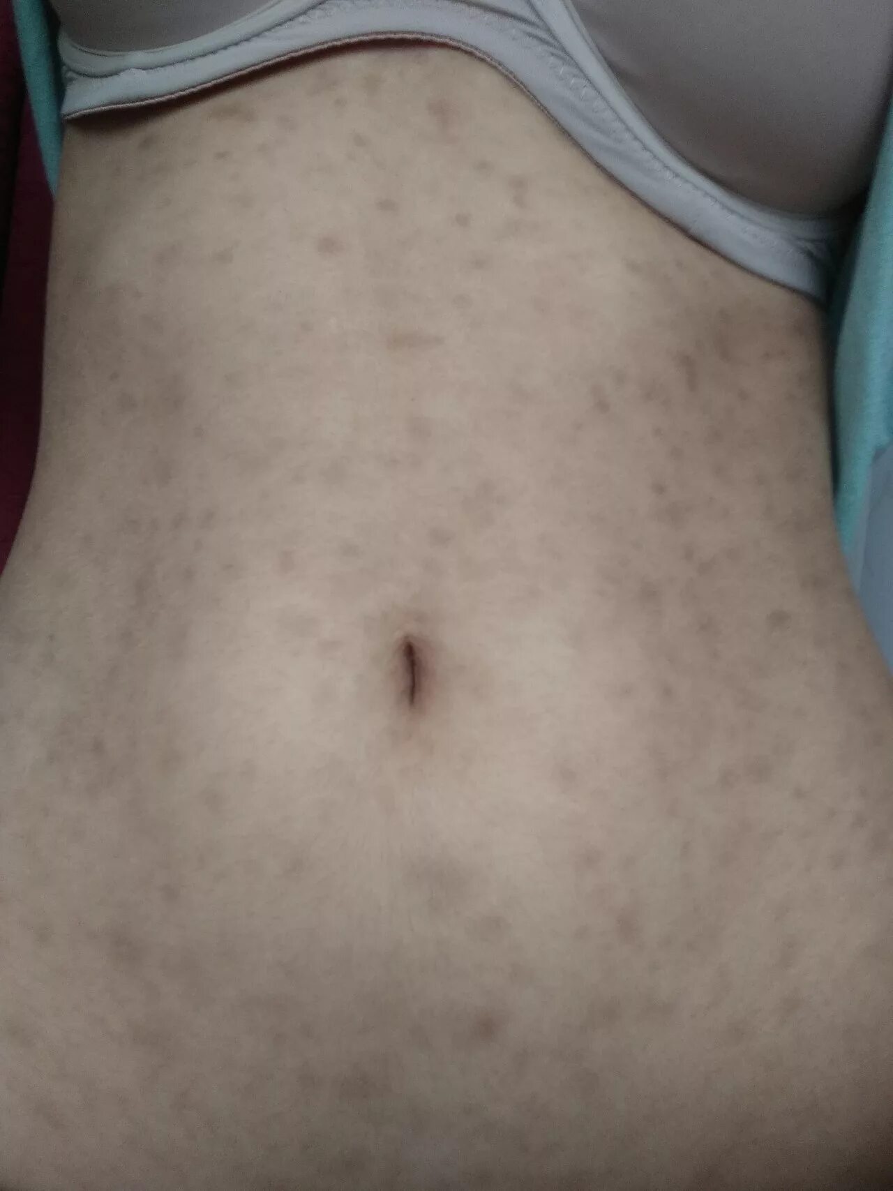 По фото определить сыпь на коже Сыпь на теле после бассейна