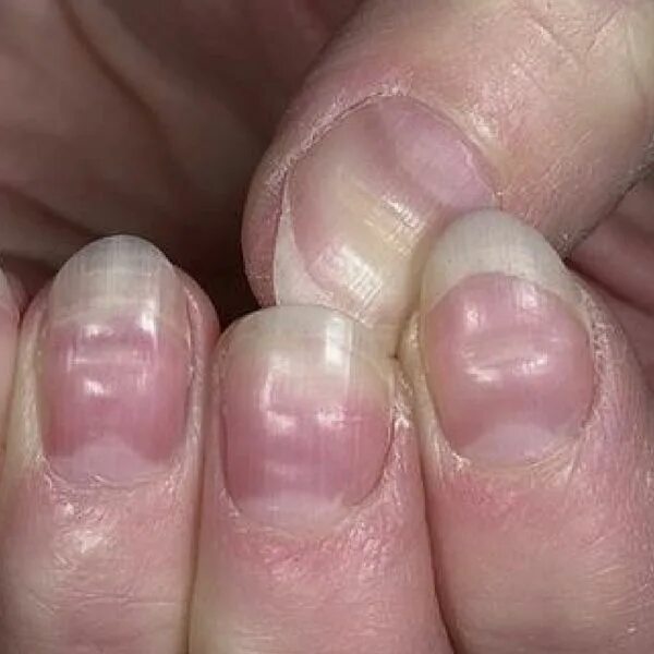По фото определить заболевание ногтей Lump Under Fingernail - Release Date Price Reviews