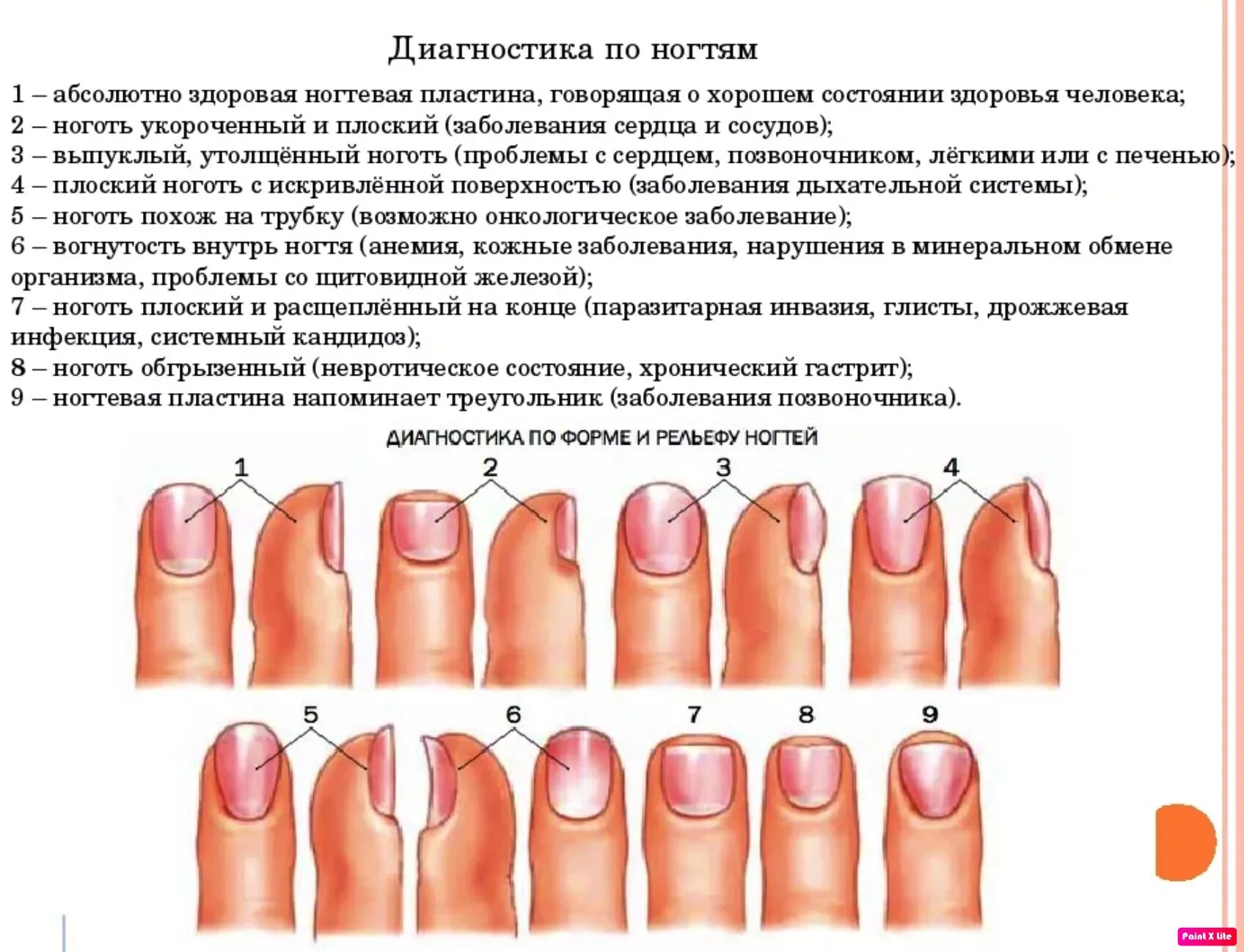 По фото определить заболевание ногтей Почему цветут ногти и что при этом делать?