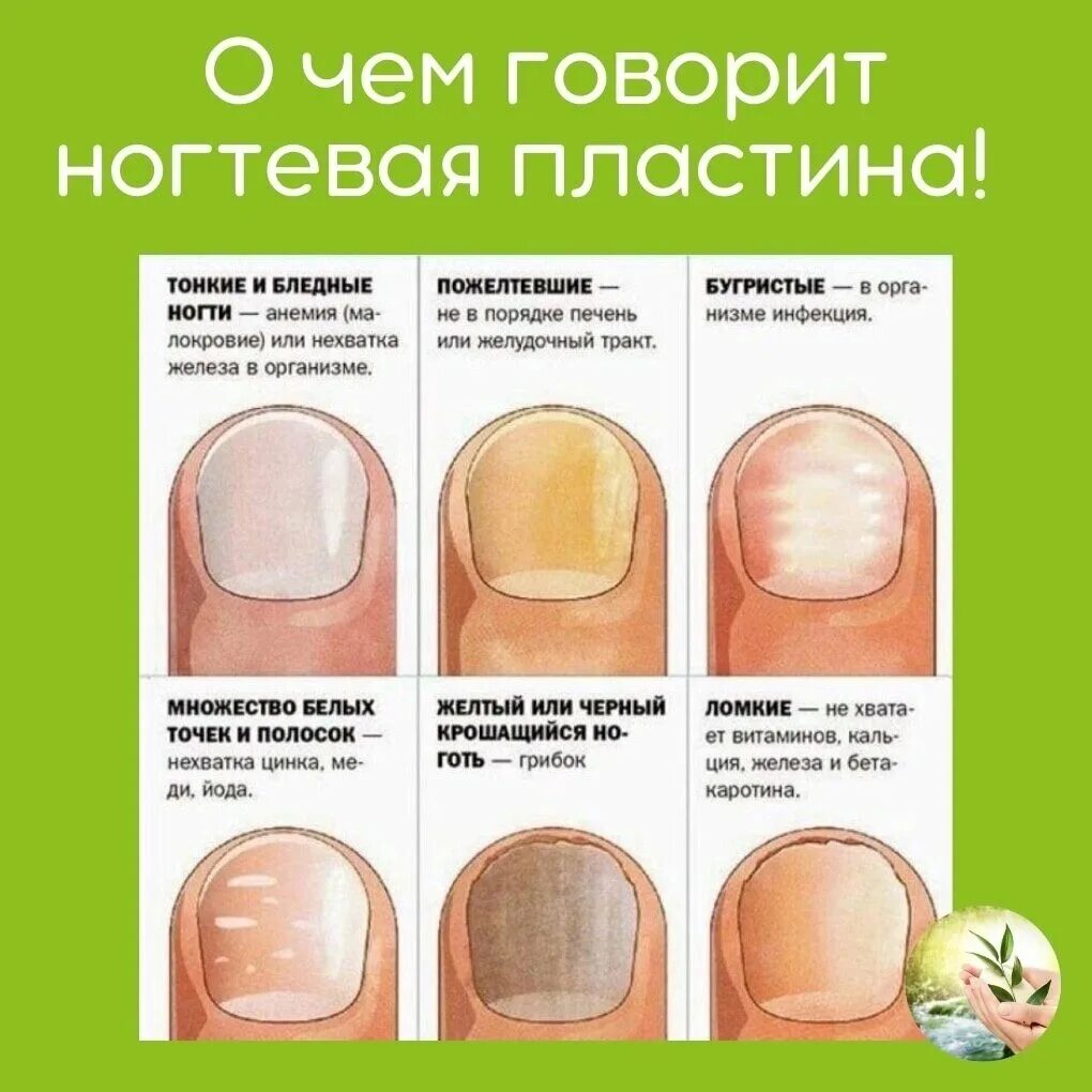 По фото определить заболевание ногтей Состояние ногтей и ваше здоровье: что они говорят о вас? Красота и здоровье Дзен
