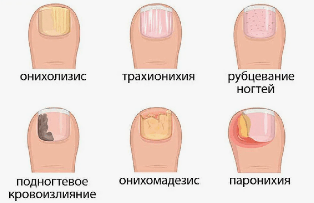 По фото определить заболевание ногтей Отслоение ногтей у детей: причины и варианты решения отслойки ногтя у ребенка