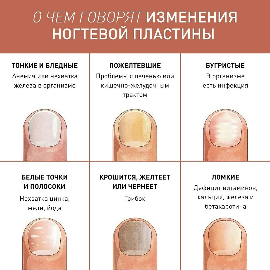 По фото определить заболевание ногтей О чем говорят изменения ногтевой пластины Идеи для жизни Фотострана Пост № 24102