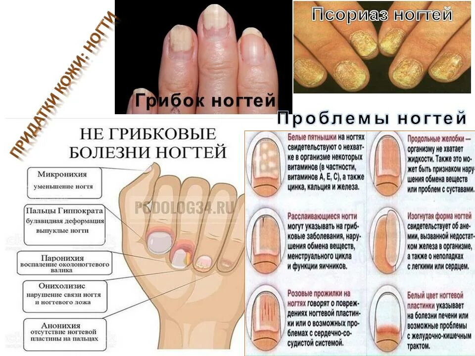 По фото определить заболевание ногтей Точки на ногтях что это: найдено 74 изображений