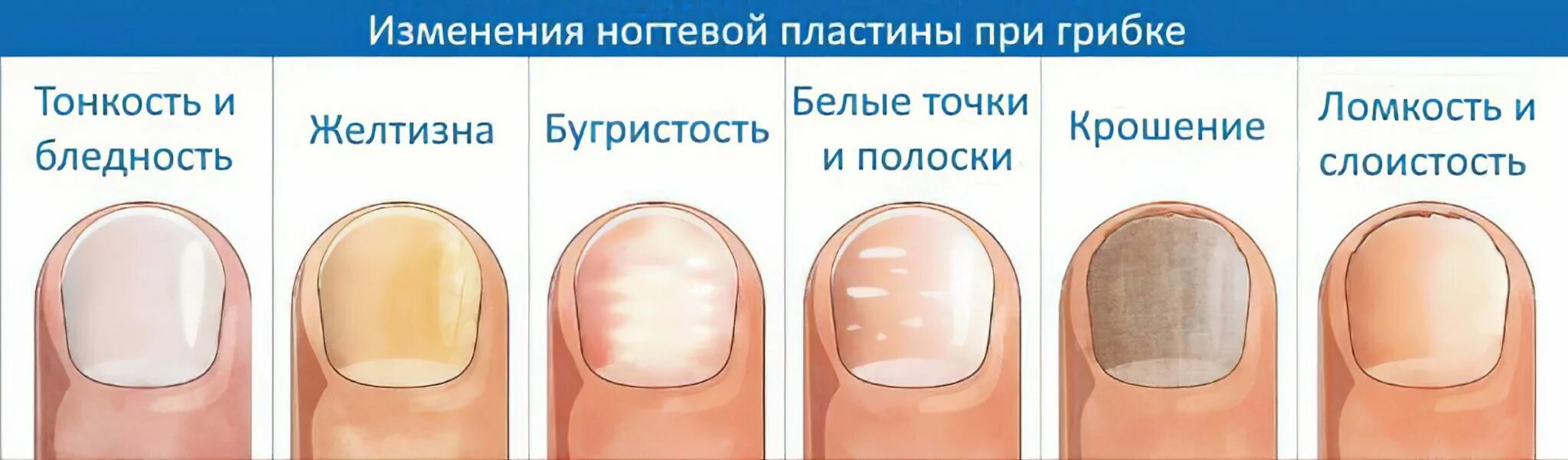 По фото определить заболевание ногтей Фотожурнал Руазел. Страница 1145475
