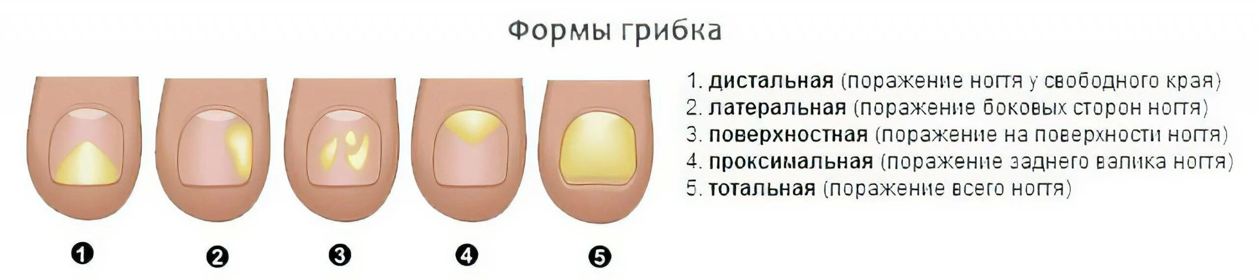 По фото определить заболевание ногтей Болезни ногтей - описание, диагностика, профилактика