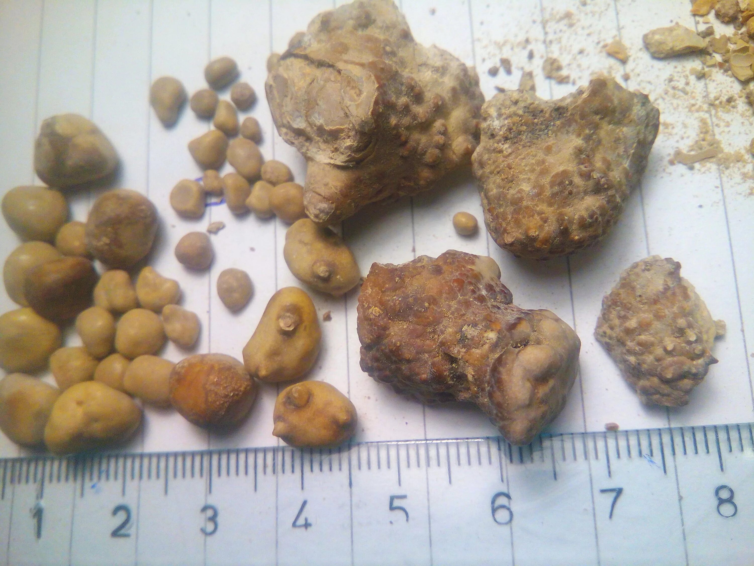 Почечные камни фото Файл:Kidney stones ( renal calculi ), Бубрежни камења 5.jpg - Википедия