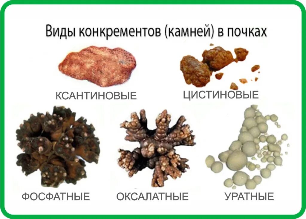 Почечные камни фото Как болят почки при МКБ: врач рассказала, как бороться с образованием камней? О 