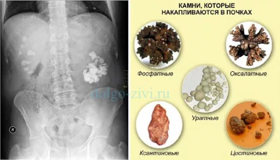 Почечные камни виды фото и описание Симптомы болезни почек - мелочи, ведущие к серьезным последствиям