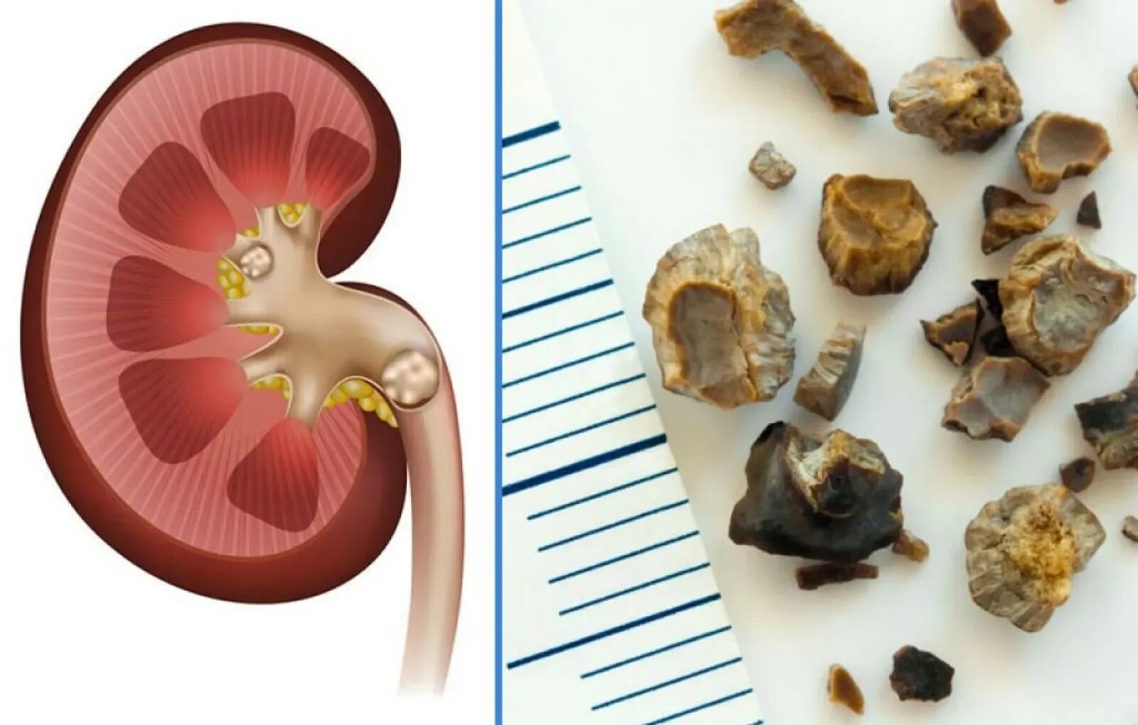 Почечные камни виды фото и описание камни в почках