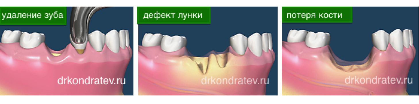 Почему бывшие удаляют фото Удаление костной ткани зуба