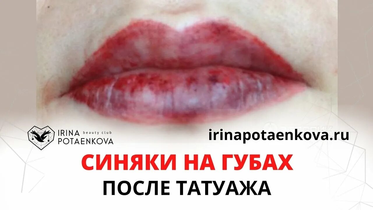 Почему герпес после татуажа Синяки на губах после татуажа? Почему? - YouTube