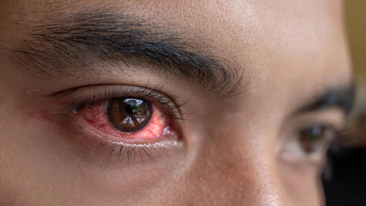 Почему на фото красные глаза Conjunctivitis symptoms, and 10 most effective tips to manage pink eye in rainy 