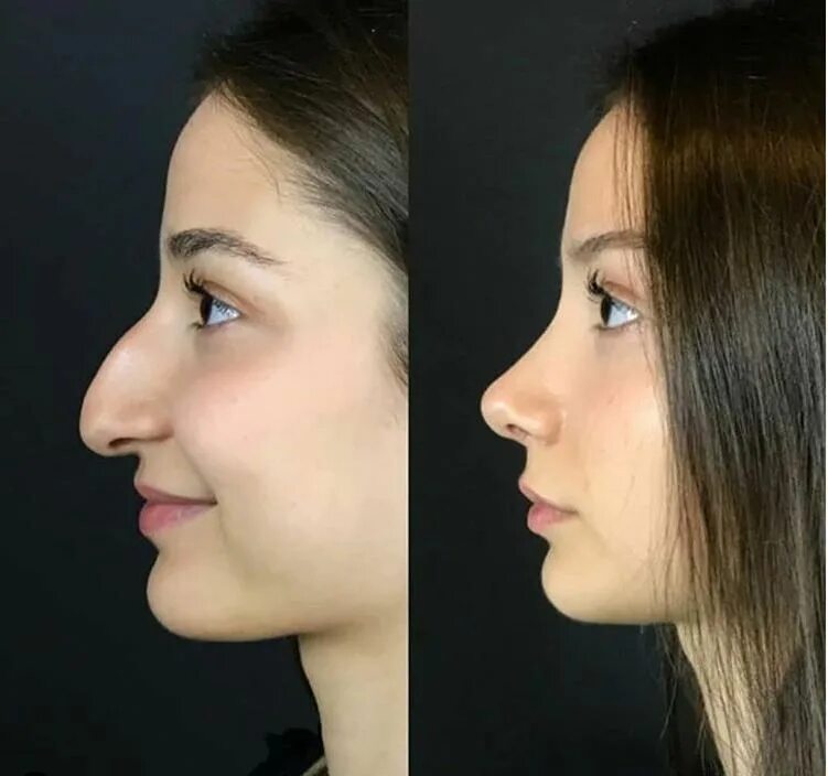 Почему на фото закрывают нос Pin on Nose Job