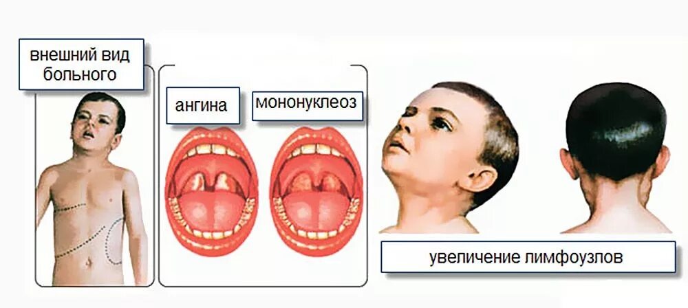 Почему симптомы фото Инфекционный мононуклеоз - ОГБУЗ "Центр общественного здоровья и медицинской