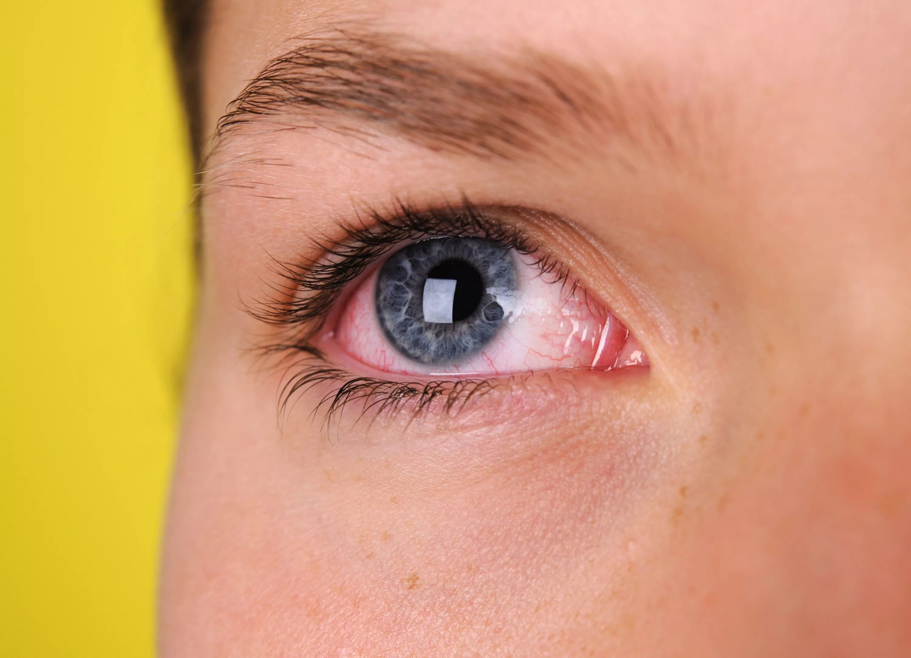 Почему слезятся глаза от макияжа Pink Eye (Conjunctivitis): Symptoms and Complications