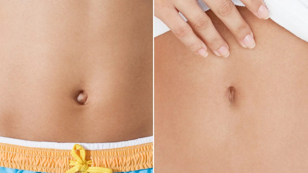 Почему закрывают пупок на фото Belly Button Plastic Surgery Turns Outties Into Innies Allure