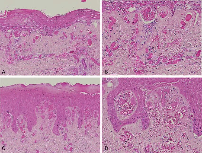 Почесуха узловатая фото симптомы и лечение A, B) Histopathology of livedoid vasculopathy skin lesions revealed... Download 