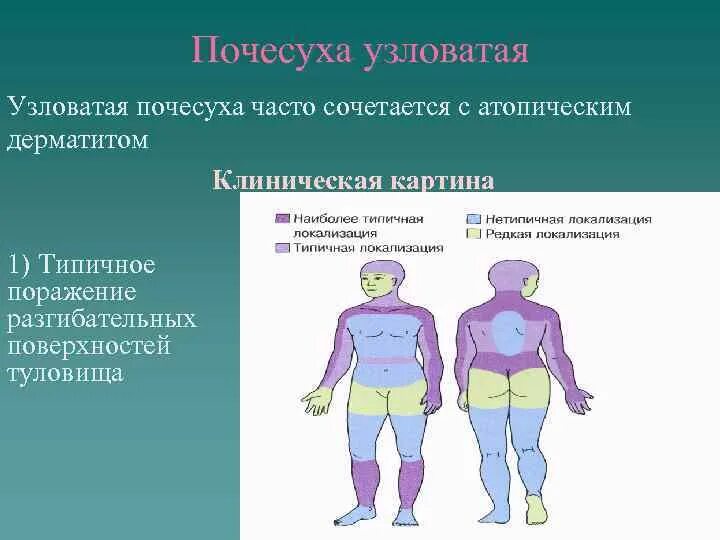 Почесуха узловатая фото симптомы и лечение Узловая почесуха (нейродермит)