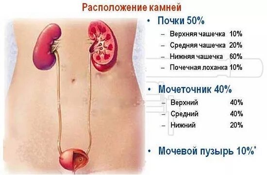 Почки где болят у женщин симптомы фото Камни в почках: причины, признаки, симптомы и лечение