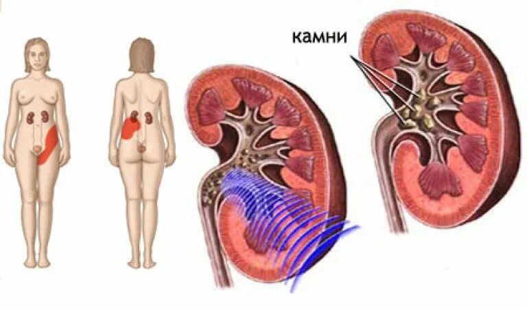 Почки где болят у женщин симптомы фото Почечная колика у женщин: симптомы и лечение, первая помощь