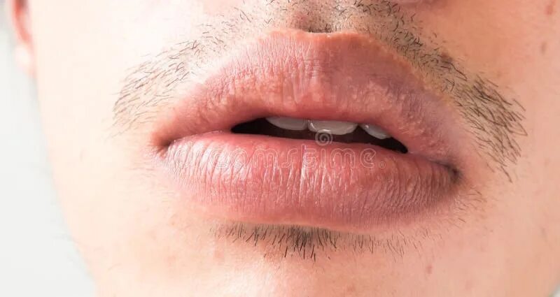 Под кожей губ белые точки фото Closeup of Lips Man Problem Health Care, Herpes Simplex Stock Image - Image of b