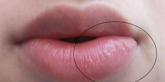 Под кожей губ белые точки фото What Does A Swollen Upper Lip Mean nda.or.ug