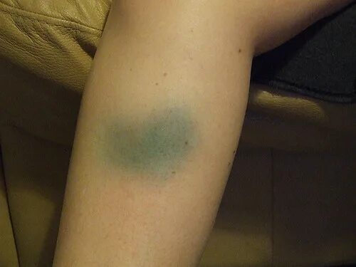 Под кожей темное пятно фото Bruised leg This is the bruising that was caused by Janets. Flickr