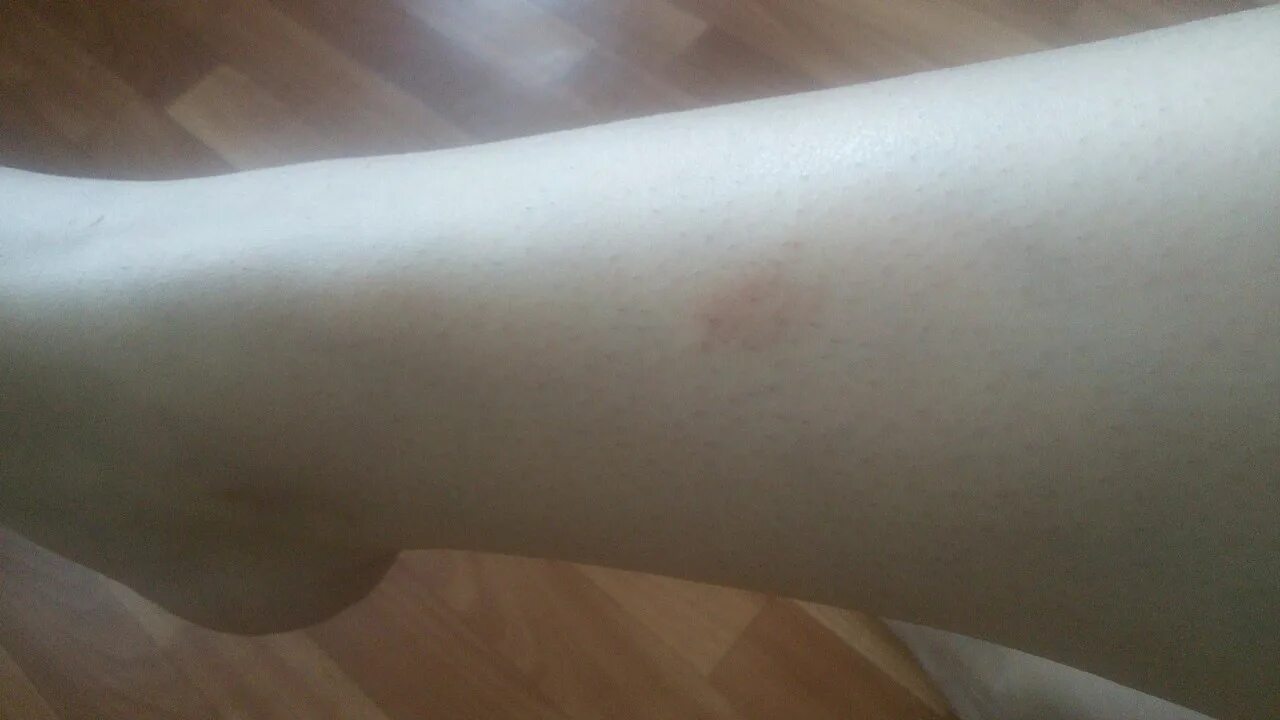 Под кожей темное пятно фото Пятна на теле похожие на засосы, держатся около 10 дней - Вопрос дерматологу - 0