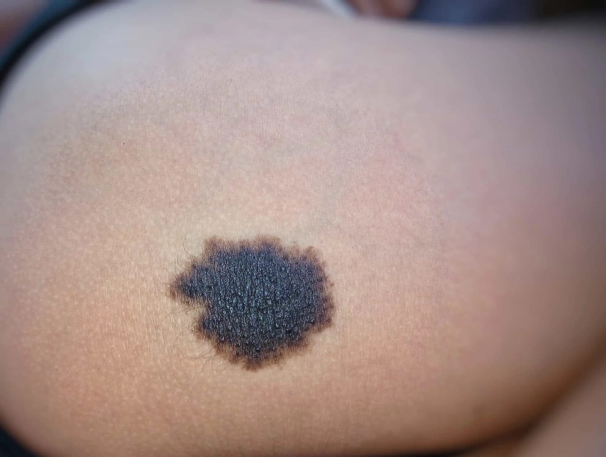 Под кожей темное пятно фото The mole guide: what does a cancerous mole look like? - Harley Medical Group