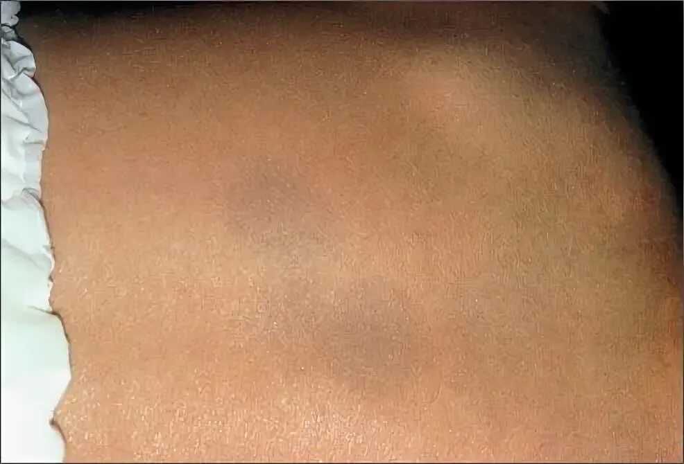 Под кожей темное пятно фото Overview of Pigmented Birthmarks