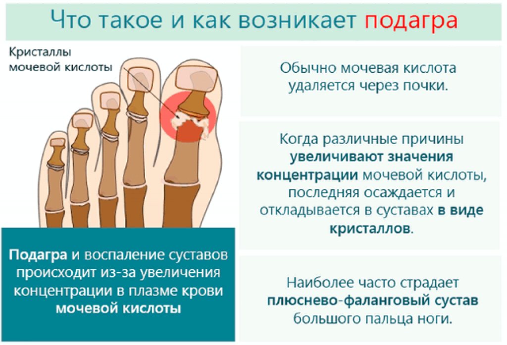 Подагра болезнь симптомы фото лечение Подагра причины заболевания признаки
