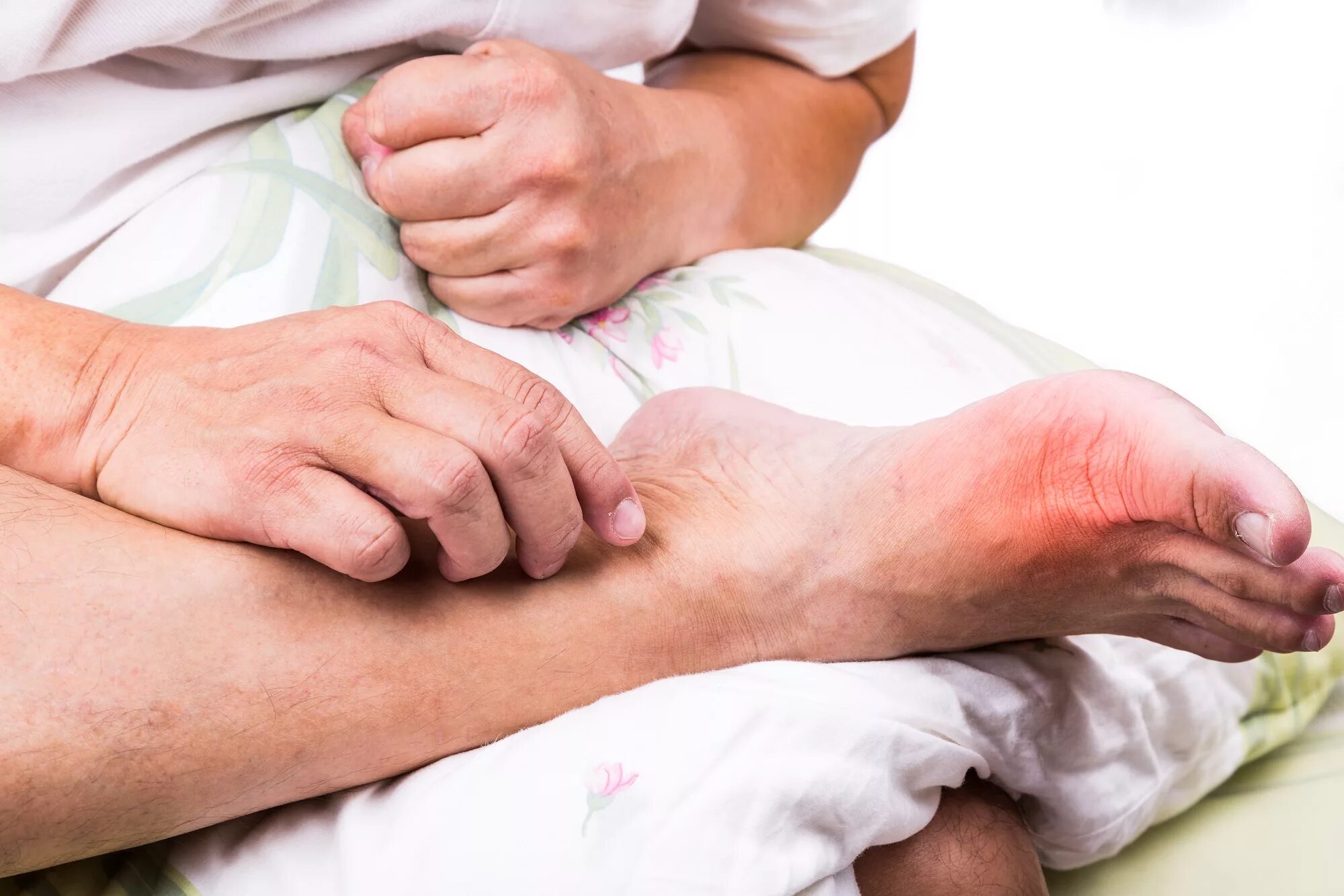 Подагра болезнь симптомы фото лечение Sufficient Vitamin D Levels May Improve Foot Pain in Knee OA - Clinical Pain Adv