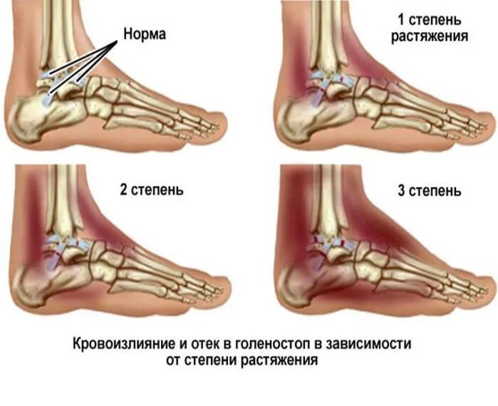 Подагра голеностопного сустава симптомы и лечение фото Лодыжка опухла и болит - что делать