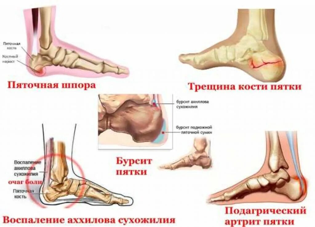 Подагра голеностопного сустава симптомы и лечение фото Картинки БОЛЬ В СУСТАВЕ СТОПЫ ПРИ ХОДЬБЕ