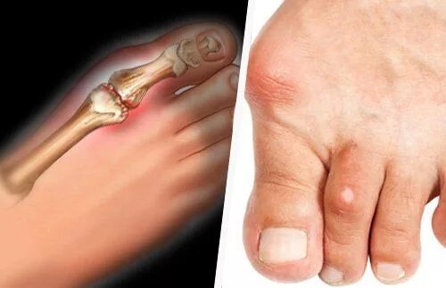 Подагра как выглядит фото Pin on Diete