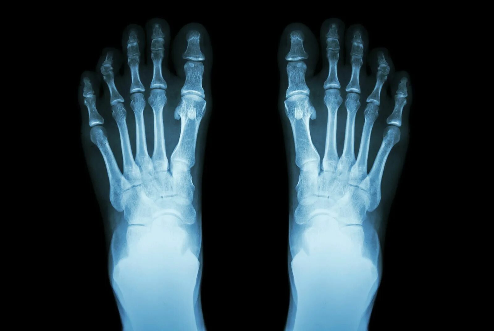 Подагра как выглядит фото Metatarsal Anatomy, Structure, & Function Britannica