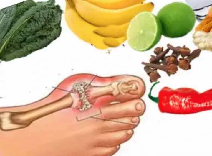 Подагра как выглядит фото Диета и питание при подагре: разрешённые продукты, меню