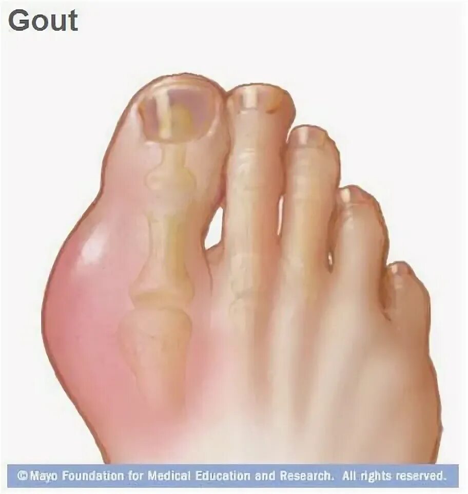 Подагра как выглядит фото Tuesday Q & A: Paying attention to diet may help prevent gout flare-up Gout symp