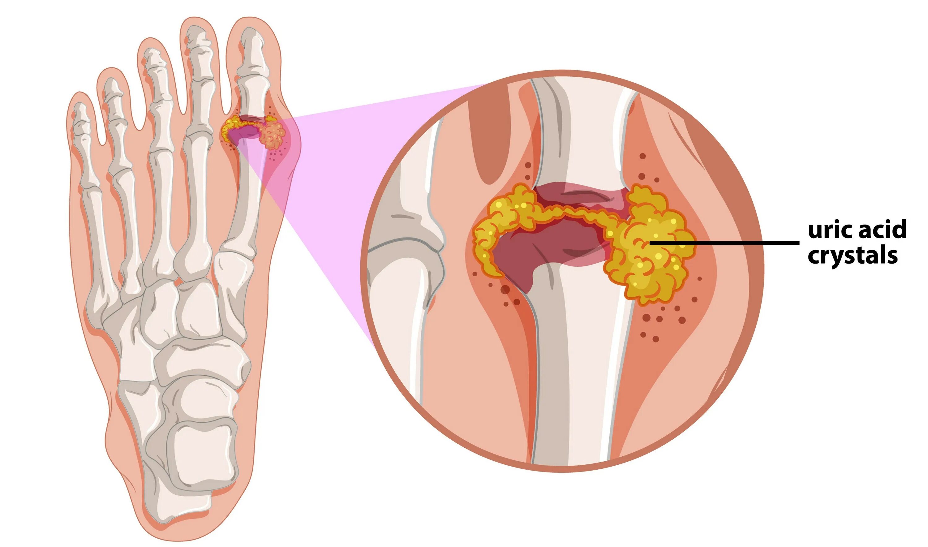Подагра как выглядит фото Inhibitors of Guanine Deaminase for Hyperuricemia and Gout Rutgers Research