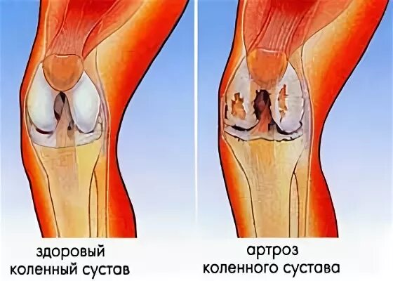 Подагра коленного сустава симптомы и лечение фото Что? " Портал "Ревматологическая помощь