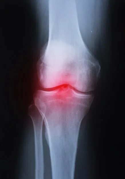Подагра коленного сустава симптомы и лечение фото Premium Photo Film x-ray knee joint with arthritis (Gout , Rheumatoid arthritis 