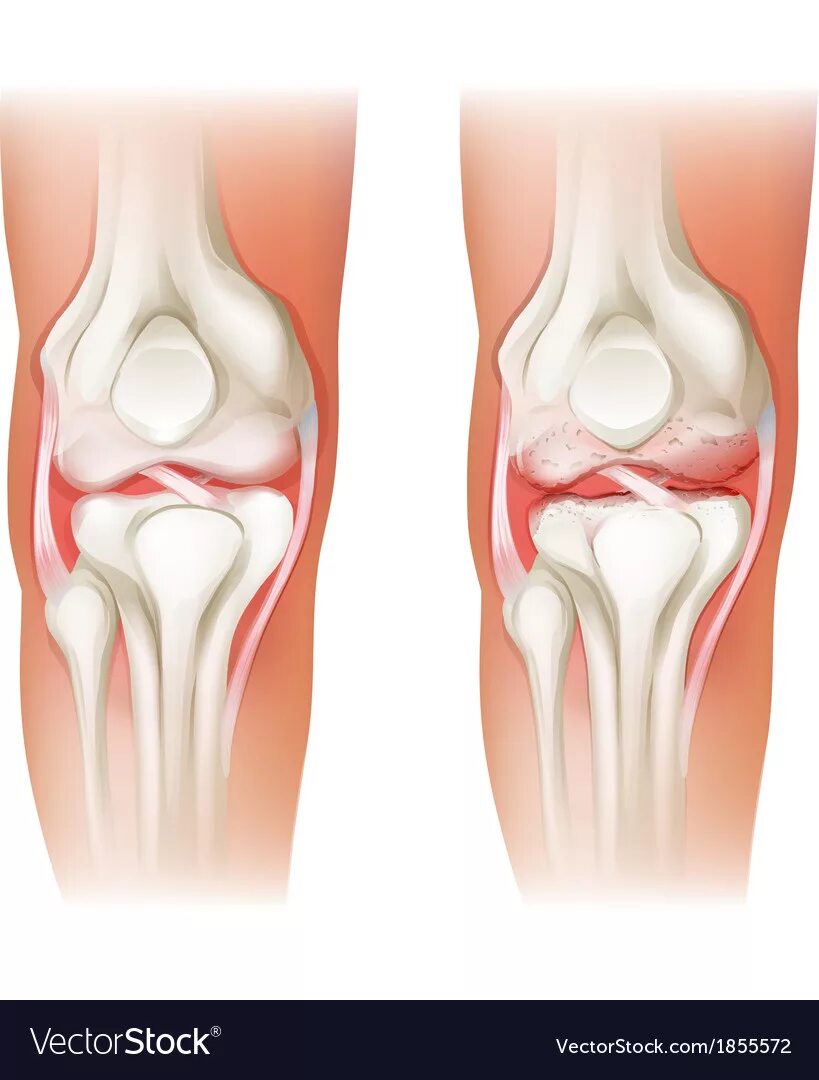 Подагра коленного сустава симптомы и лечение фото Human knee arthritis Royalty Free Vector Image