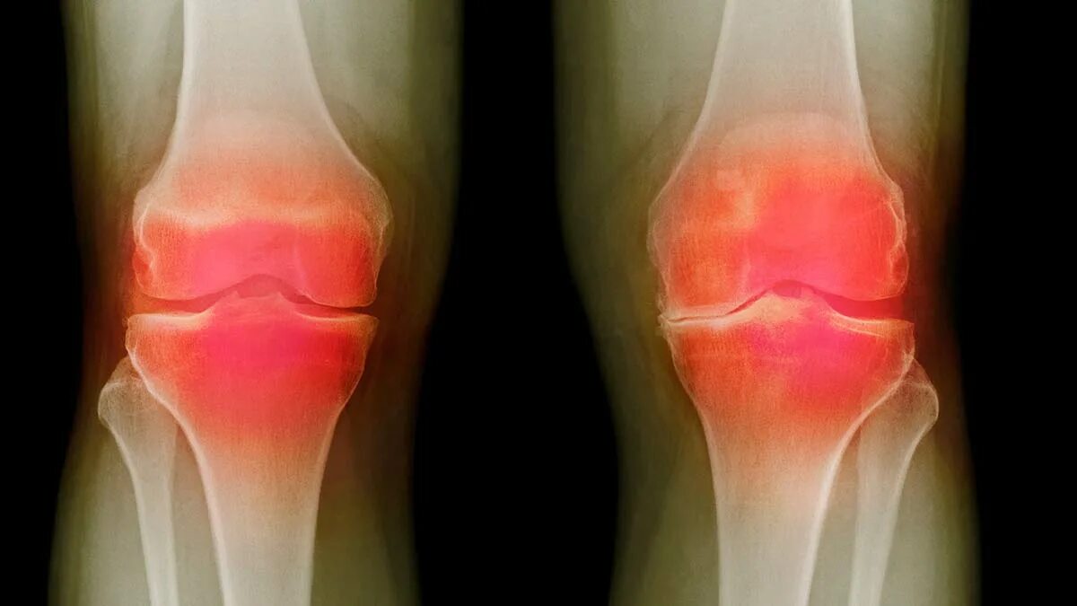 Подагра коленного сустава симптомы и лечение фото Paradigm hits record high after osteoarthritis patients report reduced knee pain